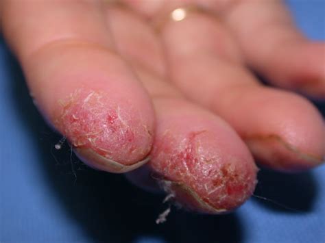 Yeast Infection Peeling Hands Guide