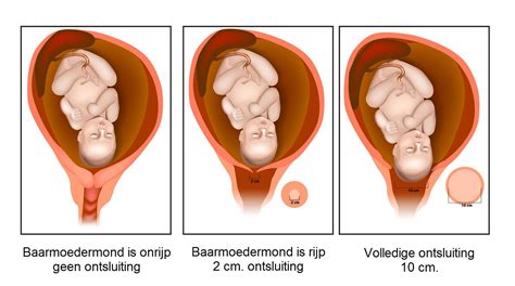 Verloop Van De Bevalling Slingeland Ziekenhuis