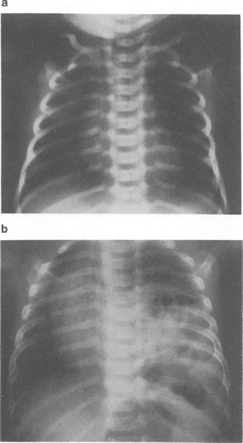 Case 1 A Normal Chest X Ray Shortly After Birth B Plain Chest