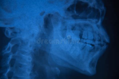 Film X Ray Skull Lateral Stock Image Image Of Skull 91043051