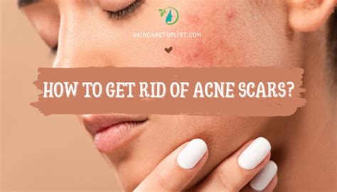 How To Get Rid Of Acne Scars Skincare Top List