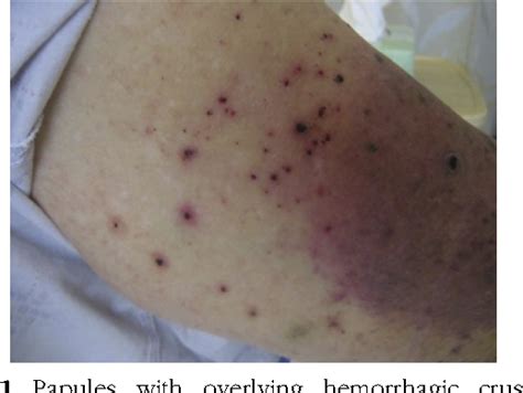 Figure 1 From Hemorrhagic Bullous Dermatosis Caused By Warfarin Therapy