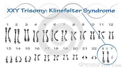 Klinefelter Syndrome Karyotype Vector Illustration XXY Trisomy