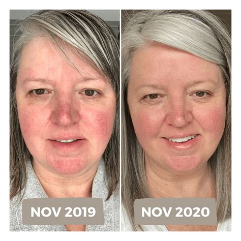 My Experience With Laser Treatment For Rosacea Including Before And After