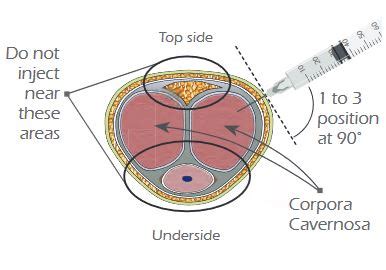 Injection Therapy Guide For Erectile Dysfunction Menmd