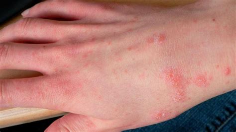 Scabies The Infuriating And Insatiable Itch Pine Belt Dermatology