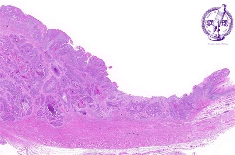 8 Esophagus Stomach 3 Esophageal Carcinoma Squamous Cell Carcinoma