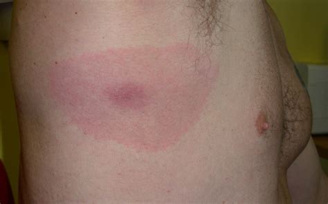 Top Tips On Avoiding Tick Bites And Lyme Disease Harringtons