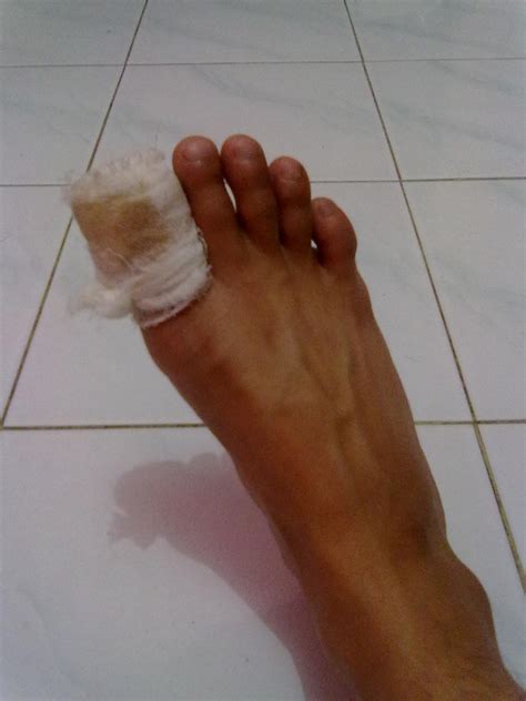 Kaki Lecet Jatuh Dari Motor - Homecare24