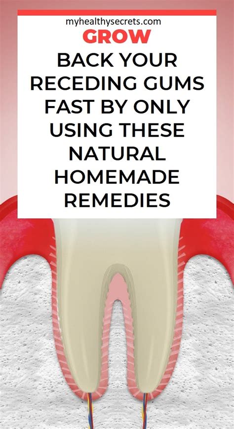 Grow Back Your Receding Gums Fast By Only Using These Natural Homemade