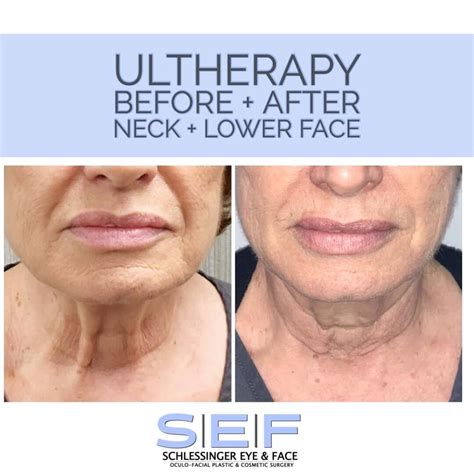 Ultherapy Long Island Ultherapy Treatment Woodbury Ny Schlessinger