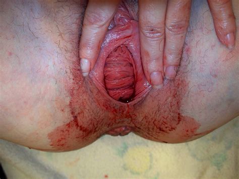 Pussy Is Bleeding After Sex Porn Pic Bleeding Pussy Xxx