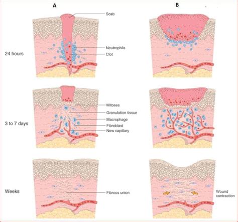 0 Result Images Of 3 Types Of Wound Repair Png Image Collection