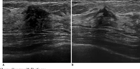 Figure 3 From Are Irregular Hypoechoic Breast Masses On Ultrasound