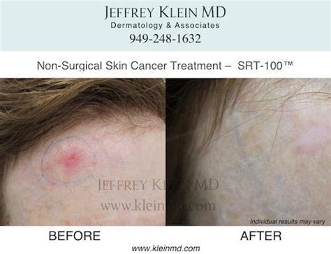 We Are Now Offering Non Surgical Skin Cancer Treatment And Keloid