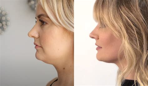 Coolsculpting Chin Before And After Reviews Photos Side Effects And
