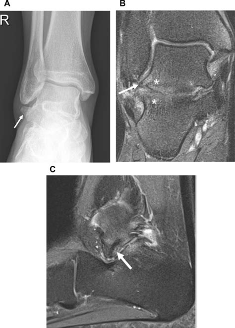 Anteroposterior Radiograph Of The Ankle With Cross Sectional Imaging