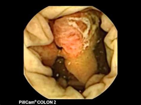How does a performance camshaft work? PillCam COLON Journey of the Colon Video - YouTube