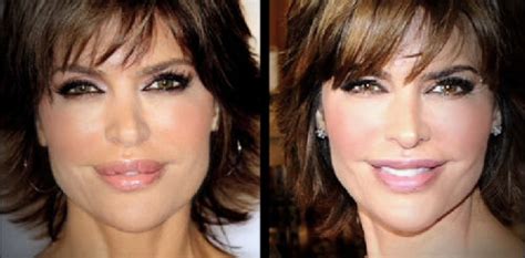 Lisa Rinna Lips Reduction Plastic Surgery Pictures