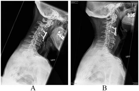 Late Onset Dysphagia From Hardware Migration After Anterior Cervical