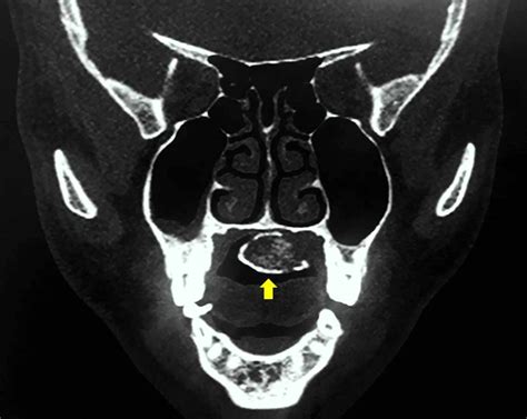 Cureus Osteolipoma An Extremely Rare Hard Palate Tumor