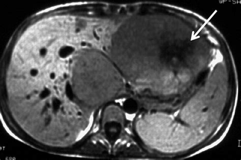 The Hypointense Liver Lesion On T2 Weighted Mr Images And What It Means
