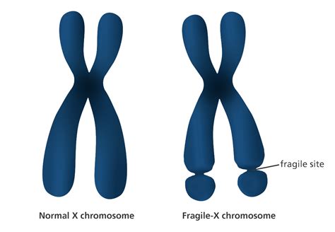 What Is Fragile X Syndrome Yourgenome