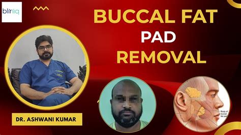 Buccal Fat Pad Removal Procedure L Chiselled Face Surgery Post Op