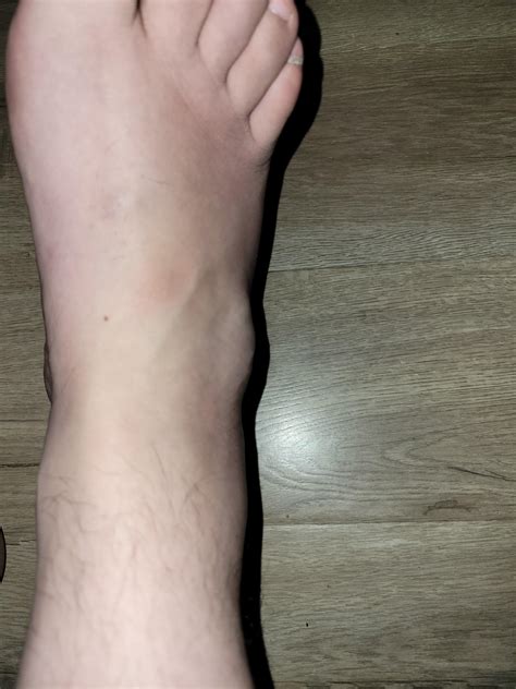 What Is This Lump Near My Ankle I Have The Same On The Other Foot
