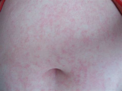 Topical Steroid Withdrawal December 2011