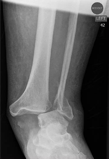 X Ray Of Ankle Joint Anteroposterior View Showing Fracture Dislocation
