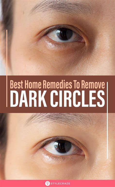 27 Best Home Remedies To Remove Dark Circles Under Eyes Permanently If