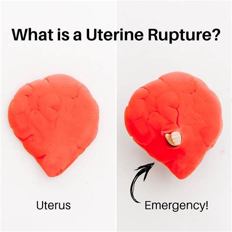 What Is A Uterine Rupture New Moms Forum
