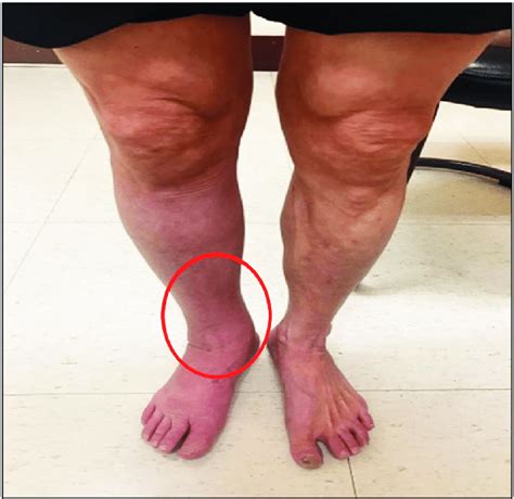 Shortening Of Lower Limbs Causes