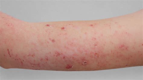 Dupixent® Dupilumab Results In Teens With Eczema