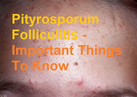 Pityrosporum Folliculitis Psoriasis Things To Know Acne