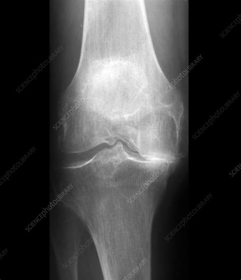 Arthritis Of The Knee X Ray Stock Image F0033496 Science Photo