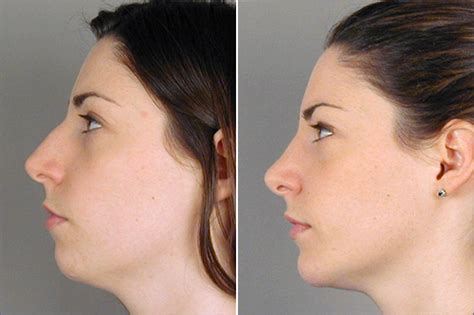 Rhinoplasty And Chin Implant Patient 8 Parker Center For Plastic Surgery