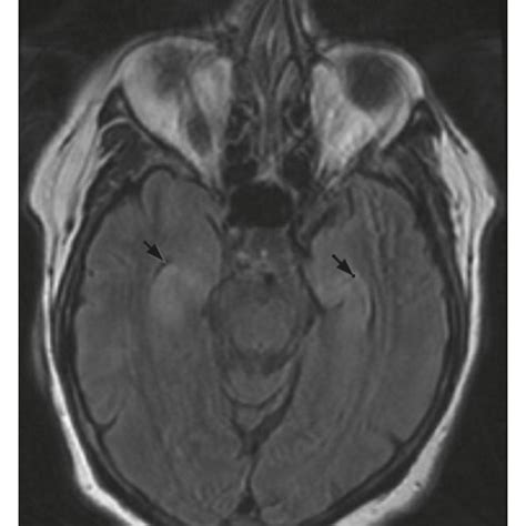 Brain Mri Revealing Symmetric Signal Abnormality Swelling Of The
