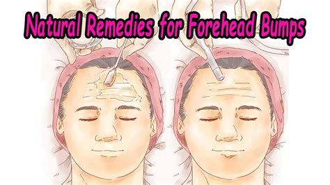 Forehead Bumps These Natural Home Remedies Can Help You Get Rid Of Them