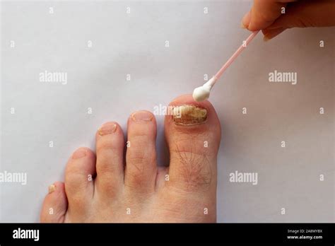 Toenail Care Hi Res Stock Photography And Images Alamy