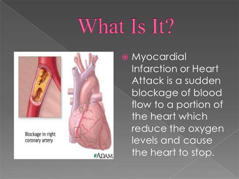Myocardial infarction (mi) is defined as a clinical (or pathologic) event in the setting of myocardial ischemia in which there is evidence of myocardial injury. Heart attack ppt