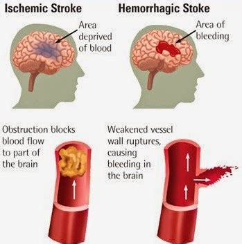Klasifikasi Penyakit Stroke Info Stroke