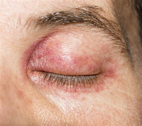 Red Swollen Eyelids Atopic Dermatitis Challenge Center Hot Sex Picture