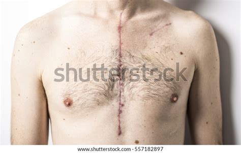 Scar Open Heart Surgery Where Sternum Stock Photo Edit Now 557182897