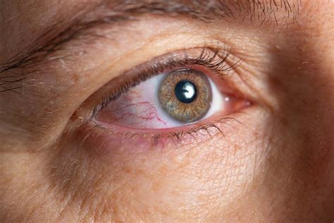 Allergies Or Pink Eye How To Tell The Difference