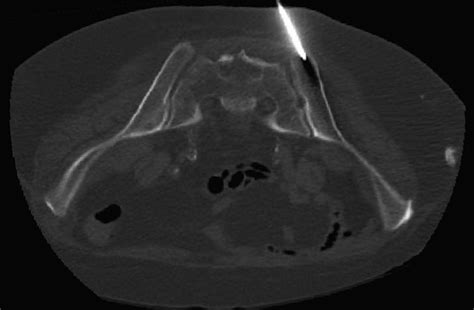 Safety Of Ct Guided Bone Marrow Biopsy In Thrombocytopenic Patients A