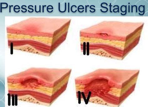 Pressure Ulcer Information Ideas Pressure Ulcer Ulcers Wound Care