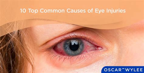 10 Top Common Causes Of Eye Injuries