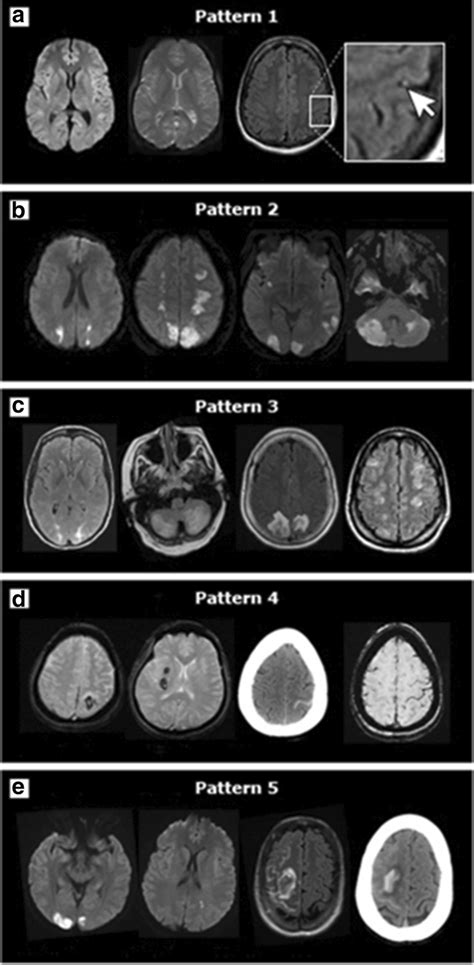 Brain Mri Findings In Rcvs Representative Brain Images From Patients